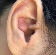 Keloid Scar Treatment Removal For Toronto Barrie Mississauga The Centre For Minor Surgery
