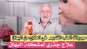 Efotbal cz euro 2021 tipy na sazeni. Ø¹Ù„Ø§Ø¬ Ø§Ù„Ø¨Ù‡Ø§Ù‚ Ù†Ù‡Ø§Ø¦ÙŠØ§