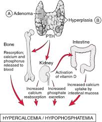 Image result for Hyperparathyroidism