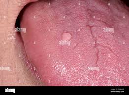 Image result for papillomavirus tongue)