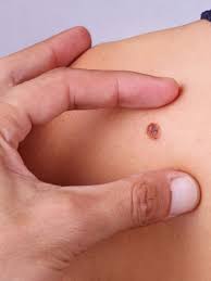Carcinoma is a type of skin cancer that does not usually spread to other areas of the body, while melanoma is a more destructive form of cancer that is lik carcinoma is a type of skin cancer that does not usually spread to other areas of th. Merkel Cell Carcinoma Skin Cancer Rates Rising In U S Allure