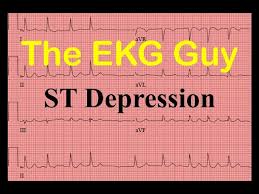 Learn vocabulary, terms and more with flashcards, games and other compare/contrast stemi and nstemi for : Ekg Ecg St Segment Depression Question 15 0 The Ekg Guy Youtube