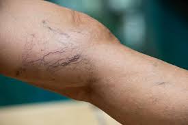 Understanding The Basics Of May Thurner Syndrome Diego Hernandez Md Vascular Surgeon