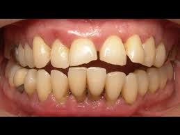 Treatment Of Advanced Gum Periodontal Disease Youtube