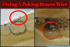 I understand being tempted to cut your braces wire with scissors as i was a brace face myself for 5 years straight. How To Fix A Poking Wire On Braces Orthodontic Braces Care