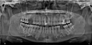 Image result for Gardner Sendromu