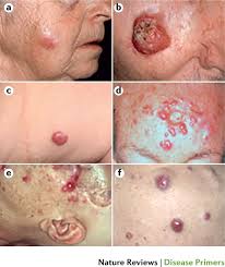 Image result for Merkel Cell Carcinoma