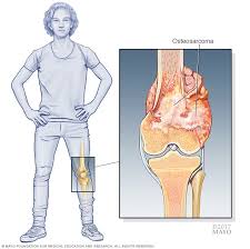 It can grow in any of the bones in the body. Bone Cancer Symptoms And Causes Mayo Clinic