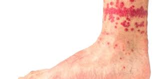 Image result for flea bites
