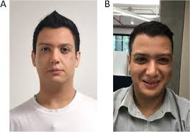 Urofacial (Ochoa) syndrome with a founder pathogenic variant in the HPSE2  gene: a case report and mutation origin