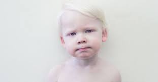 Porcelanowi ludzie. Jak żyje się z albinizmem?