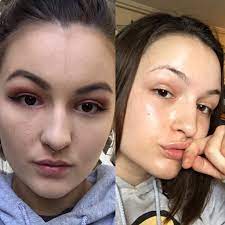 Found This Old Picture Of Myself And Couldn T Believe How Much My Skin Has Improved About 1 Year Into Skincare Asianbeauty