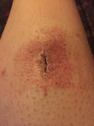 Sheila calderon answered 41 years experience internal medicine yes: What Is This Rash Around My Incision Site Photo