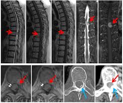 脊髄腫瘍（脊髄髄内腫瘍、脊髄髄外腫瘍、馬尾腫瘍） 脊髄空洞症 syringomyelia 疾患概念 脊髄実質内に髄液の貯留が起こり、拡大伸展すると種々の脊髄症状を生じる。なぜ脊髄内に髄液の侵入が起こり、拡大していくかについては未だ明らかでない。 è„Šé«„è…«ç˜ æ„›çŸ¥åŒ»ç§'å¤§å­¦ç—…é™¢