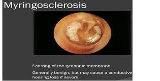 Image result for Myringosclerosis