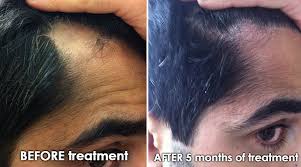 This foam formula is perfect for the early stages of hair loss and is supposed to regrow up to 25 percent more hair. Murray Avenue Apothecary Hair Loss