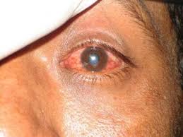 Image result for Eye Foreign Body