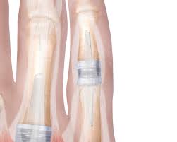 · anatomical sizing (length, height, width) is available in eleven sizes to meet various operative. Integra Silicone Pip Implant