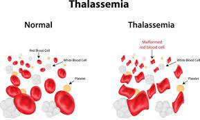 Thalassaemia) adalah penyakit kecacatan darah. Dilema Pesakit Talasemia