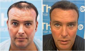 1. before-after-face. ben-thornley.png