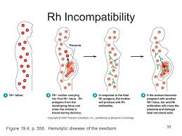 80 Memorable Rh Incompatibility Chart