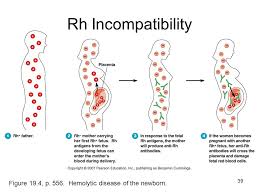 80 memorable rh incompatibility chart