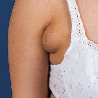 Armpit Lumps During Pregnancy Obstetric Excellence Norwest