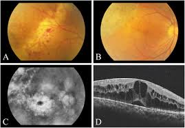 Image result for HIV Retinitis