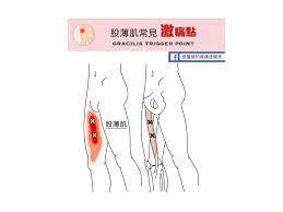 大腿痛-股薄肌常見激痛點» 台北原力復健科診所-侯鐘堡醫師