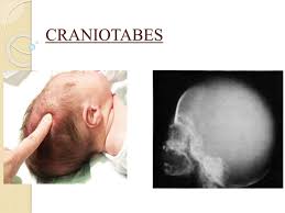Image result for Craniotabes