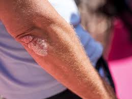 Image result for Auspitz Sign