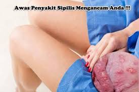 Gejala sipilis atau sifilis digolongkan sesuai dengan tahap perkembangan penyakitnya. Obat Antibiotik Sipilis Buatan Sendiri De Nature