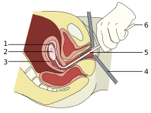 Abortion Wikipedia