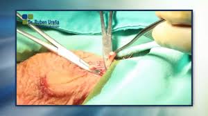 Vasectomia, cunoscuta si sub numele de sterilizare masculina, este procedura medicala prin care canalele deferente care pleaca de la testicule, cele prin care este ejaculat lichidul seminal (sperma). Dr Ruben Urena Vasectomia Cirugia Youtube