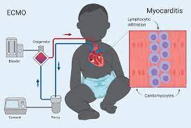 The symptoms of heart failure from . The Use Of Extracorporeal Membrane Oxygenation In Children With Acute Fulminant Myocarditis