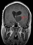Image result for what is treatment for brain tumor in thalamus?