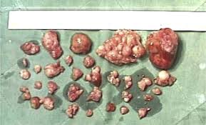 It helps to become aware of the signs of ovulation, such as a change in your cervical mucus. How To Manage Multiple Fibroids In Reproductive Laparoscopic Surgery Sciencedirect
