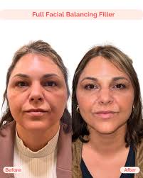 Facial balancing isn't about changing who you are. It is about enhancing  the beauty you already have. This gorgeous patient wanted soft, harmonious  contouring, so we treated several areas to bring balance,