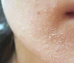 What Causes Dry Skin On Face A Look Into The Dry Flaky Skin On Face Causes Home Remedies How Face Dry Skin Remedies Flaky Skin On Face Dry Skin Around Eyes