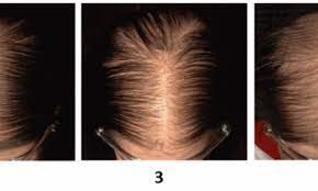 Research shows that people with alopecia areata have much lower. Vitamin D Supplements Improve Hair Regrowth In Patients With Diffuse Hair Loss Study