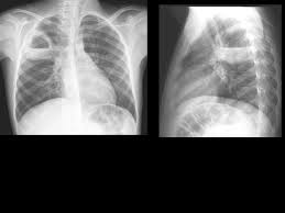 Image result for Lung Abscess