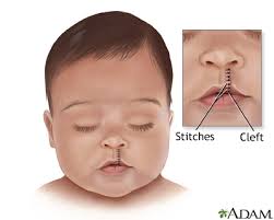 Image result for Cleft Lip
