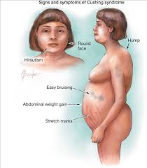 The Depo Shot Is Transforming Women S Bodies Cushings Syndrome Cushing Disease Endocrine System