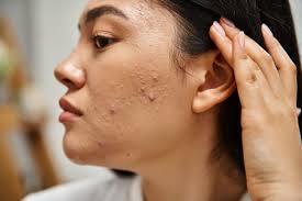 Image result for acne face
