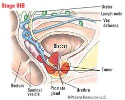 In the absence of a national coverage determination, Patient Resource Publishing Prostate Cancer Staging