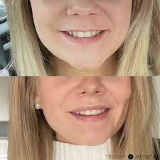 Trouve Medspa Lip Flip Cleveland