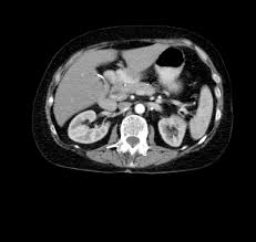 Check spelling or type a new query. Acute Pancreatitis Knowledge Amboss