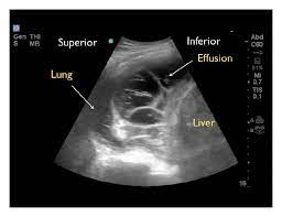 Rather, any underlying disease that has been identified (congestive heart failure thoracic ultrasound for pleural effusion in the intensive care unit: Ultrasound For The Detection Of Pleural Effusions And Guidance Of The Thoracentesis Procedure