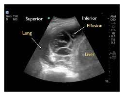 Seeding of the pleural space by bacteria or rarely fungi is usually from extension from adjacent pulmonary. Ultrasound For The Detection Of Pleural Effusions And Guidance Of The Thoracentesis Procedure