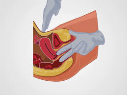 Pelvic Exam Iii Bimanual And Rectovaginal Exam Protocol Translated To German